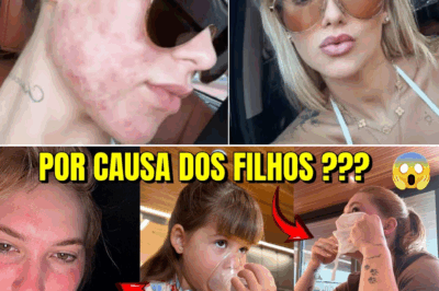 O dia em que Virgínia apareceu com o rosto queimado e revelou a verdade por trás da luta contra a acne